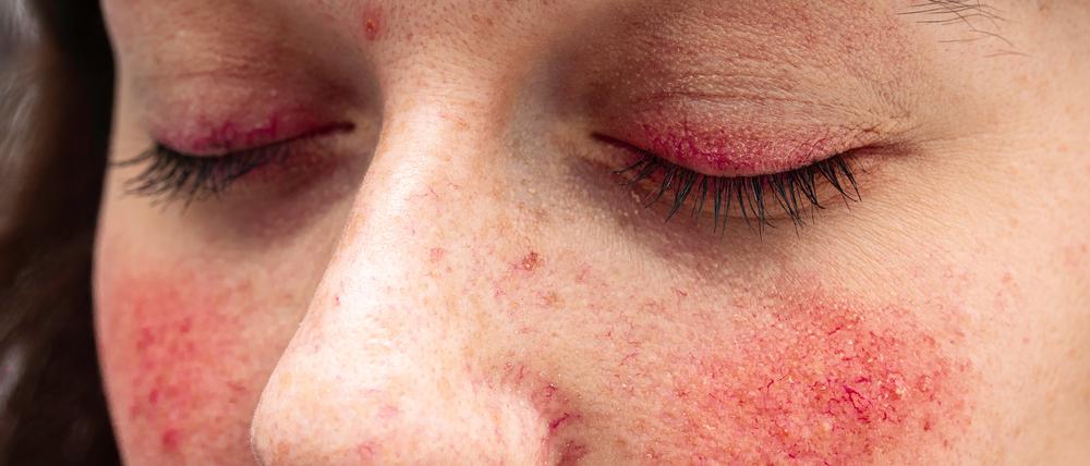 Weil Rosacea mitten im Gesicht auftritt und sich nur mühsam verbergen lässt, leiden viele Betroffene auch seelisch.