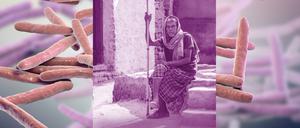 Die Lepra-verursachenden Bakterien (Mycobacterium leprae) werden mit Tröpfchen oder als Schmierinfektion übertragen. Erkrankte werden vielerorts sozial ausgegrenzt.