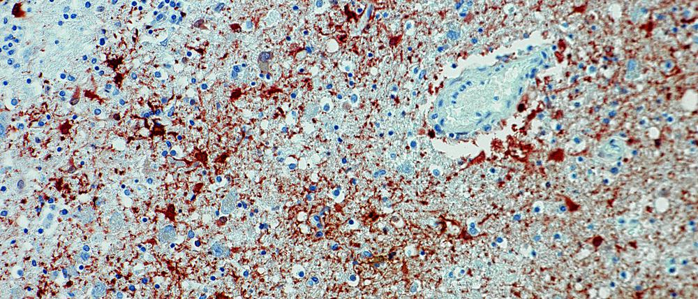 Die undatierte Aufnahme zeigt einen Anitkörpernachweis zum Borna-Virus im Gewebe. In Bayern ist eine sehr seltene Infektion mit dem Borna-Virus nachgewiesen worden.