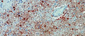 Die undatierte Aufnahme zeigt einen Anitkörpernachweis zum Borna-Virus im Gewebe. In Bayern ist eine sehr seltene Infektion mit dem Borna-Virus nachgewiesen worden.