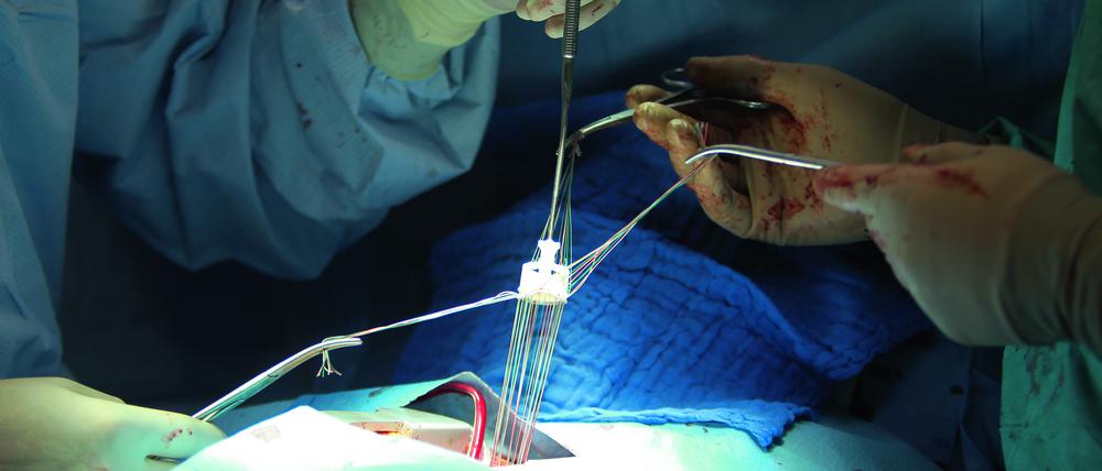 Chirurgen setzten im Operationssaal der Klinik für Herz- und Thoraxchirurgie an der Universitätsklinik Köln einem Patienten einen Herzklappenersatz ein.