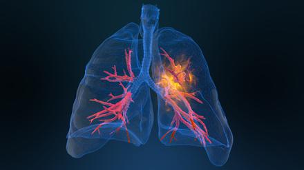Forscher in den USA haben an Mäusen erfolgreich eine neue Form der Krebsdiagnostik getestet. Sie hat das Potenzial, Krebserkrankungen im Frühstadium zu diagnostizieren.