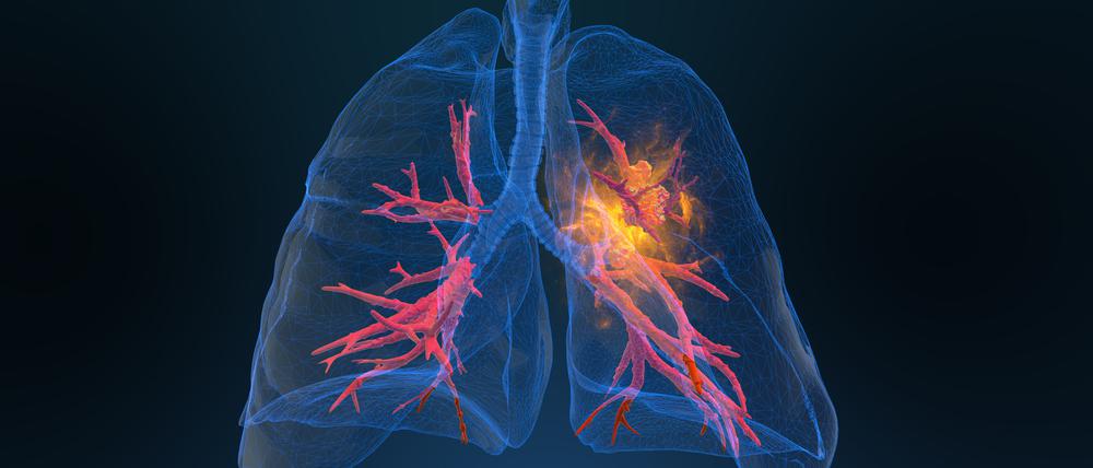Forscher in den USA haben an Mäusen erfolgreich eine neue Form der Krebsdiagnostik getestet. Sie hat das Potenzial, Krebserkrankungen im Frühstadium zu diagnostizieren.