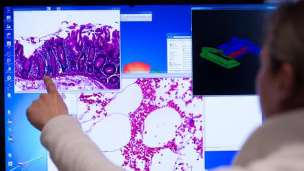 Ein Mitarbeiter zeigt im Institut der Pathologie der Universitätsklinik Charité in Berlin an einem Computerbildschirm auf eine Darstellung einer eingescannten Probe eines Stück Gewebes aus dem Dickdarm, das bei einer Operation entnommenen wurde. 
