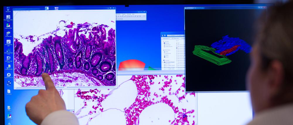 Ein Mitarbeiter zeigt im Institut der Pathologie der Universitätsklinik Charité in Berlin an einem Computerbildschirm auf eine Darstellung einer eingescannten Probe eines Stück Gewebes aus dem Dickdarm, das bei einer Operation entnommen wurde. 