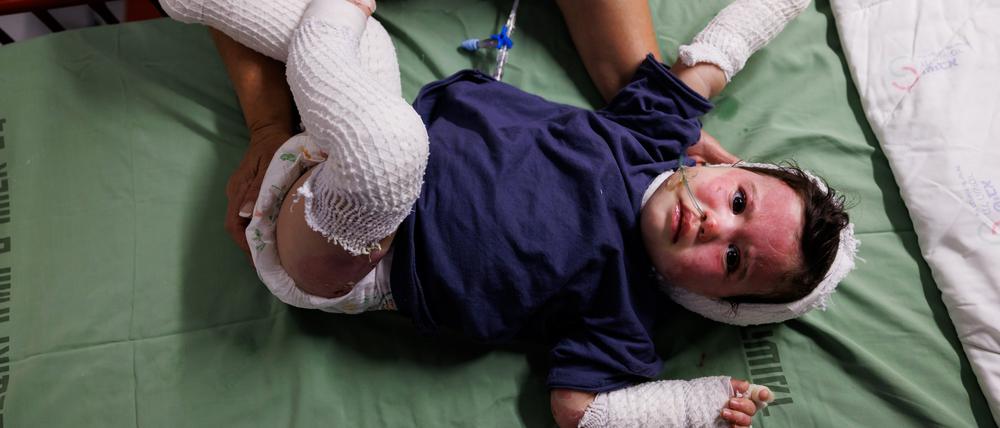 Aufnahme vom 24. Oktober 2023 aus Tel Hashomer, Ramat Gan, Israel. Die eineinhalb-jährige Yael Golan wurde am 7. Oktober zusammen mit ihren Eltern in Kfar Aza verletzt. 30 Prozent ihrer Haut ist verbrannt.