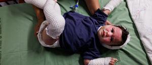 Aufnahme vom 24. Oktober 2023 aus Tel Hashomer, Ramat Gan, Israel. Die eineinhalb-jährige Yael Golan wurde am 7. Oktober zusammen mit ihren Eltern in Kfar Aza verletzt. 30 Prozent ihrer Haut ist verbrannt.