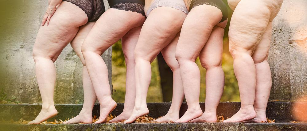 Frauen mit Lipödem stehen nebeneinander auf einer Treppe.