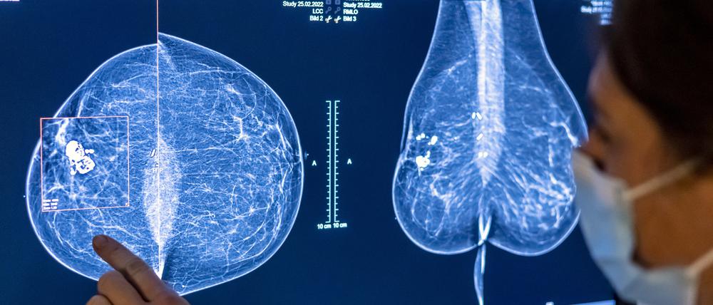 Medizinisches Personal untersucht mit einer Mammografie die Brust einer Frau auf Brustkrebs.