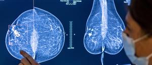 Medizinisches Personal untersucht mit einer Mammografie die Brust einer Frau auf Brustkrebs.