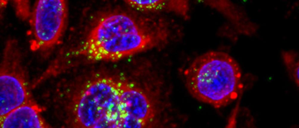 Grün ist hier leider nicht die Hoffnung, sondern das Mikro- und Nanoplastik in den Krebszellen.