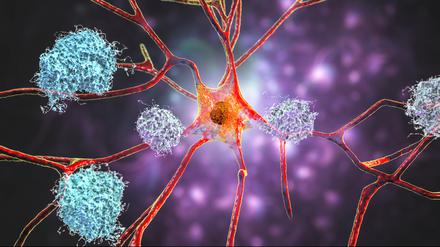 Sieht hübsch aus, ist aber sehr hässlich: Neuronen mit Zeichen der Alzheimerschen Krankheit wie Amyloid Plaques, Tau-Fibrillen und Netzwerkschäden (Illustration).