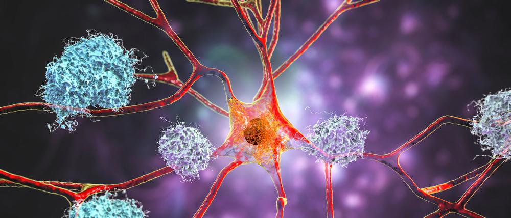 Sieht hübsch aus, ist aber sehr hässlich: Neuronen mit Zeichen der Alzheimerschen Krankheit wie Amyloid Plaques, Tau-Fibrillen und Netzwerkschäden (Illustration).