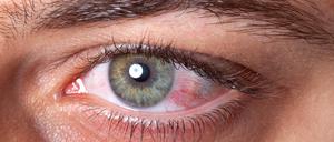 Ein gerötetes Auge eines Mannes.