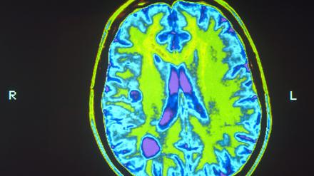 Gehirn eines MS-Patienten