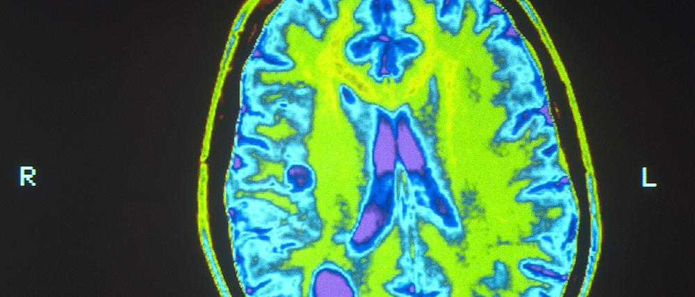 Gehirn eines MS-Patienten