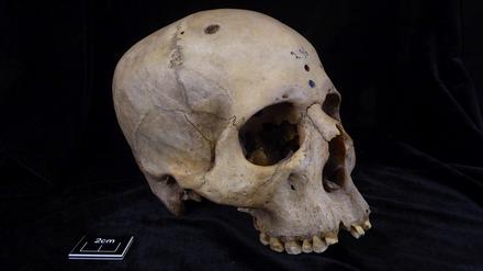 Der 4000 Jahre alte Schädel „E236“ eines etwa 30-jährigen Mannes aus dem alten Ägypten zeigt Löcher, um die herum feinste Spuren von scharfen Messern zu erkennen sind, die Forschenden zufolge die ältesten Spuren einer Krebsoperation darstellen könnten. 