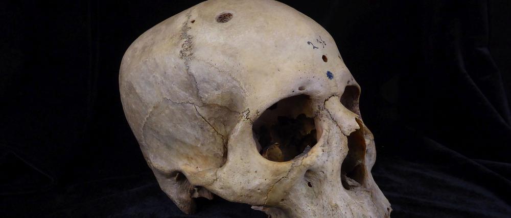 Der 4000 Jahre alte Schädel „E236“ eines etwa 30-jährigen Mannes aus dem alten Ägypten zeigt Löcher, um die herum feinste Spuren von scharfen Messern zu erkennen sind, die Forschenden zufolge die ältesten Spuren einer Krebsoperation darstellen könnten. 