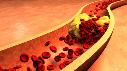 Mit Cholesterin verstopfte Arterien.