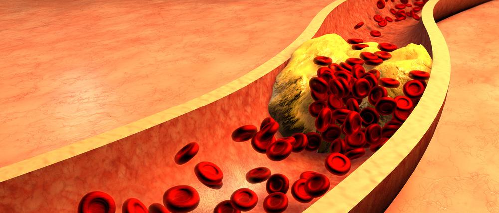 Mit Cholesterin verstopfte Arterien.