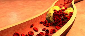 Mit Cholesterin verstopfte Arterien.