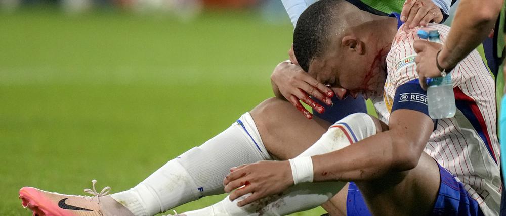 Kylian Mbappe aus Frankreich blutet nach einem Zusammenstoß aus der Nase.
