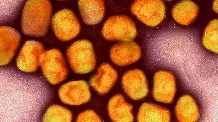 In Deutschland ist erstmals eine Infektion mit der neuen Mpox-Variante Clade Ib nachgewiesen worden (Symbolbild).