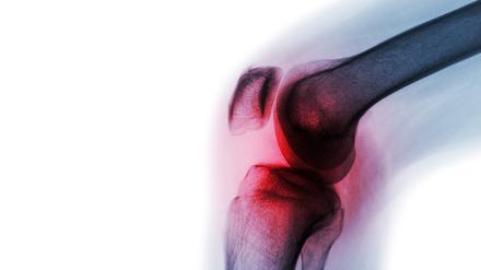 Entzündliche Erkrankungen wie Arthritis nehmen im Alter zu – jedoch eher in Industrieländern, nicht in indigenen Bevölkerungen wie im Amazonasgebiet.