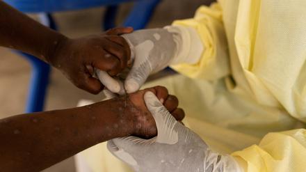 Eine Krankenschwester nimmt eine Probe von einem Kind, das mutmaßlich mit Mpox infiziert ist. 