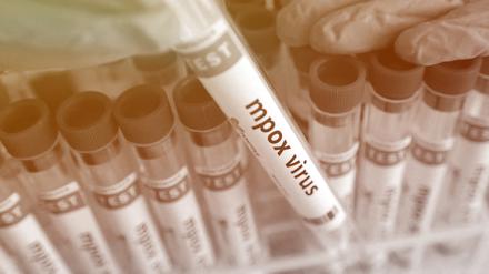 Bislang finden sich die meisten Proben mit dem Mpox-Virus in Afrika.   
