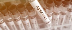 Bislang finden sich die meisten Proben mit dem Mpox-Virus in Afrika.   