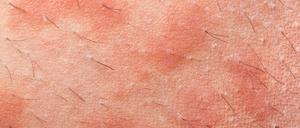 nesselsucht,nesselfieber,urtikaria *** 1un-h78