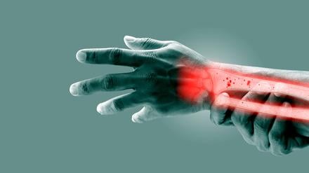 Osteoporose in Unterarm und Handgelenk. (Illustration)