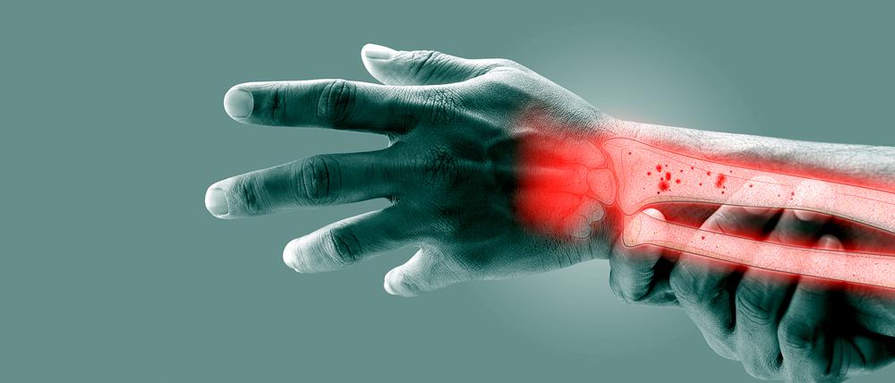 Osteoporose in Unterarm und Handgelenk. (Illustration)