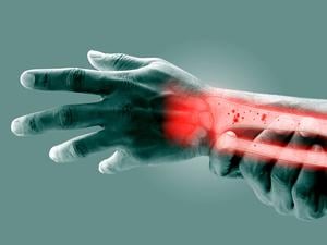 Osteoporose in Unterarm und Handgelenk. (Illustration)