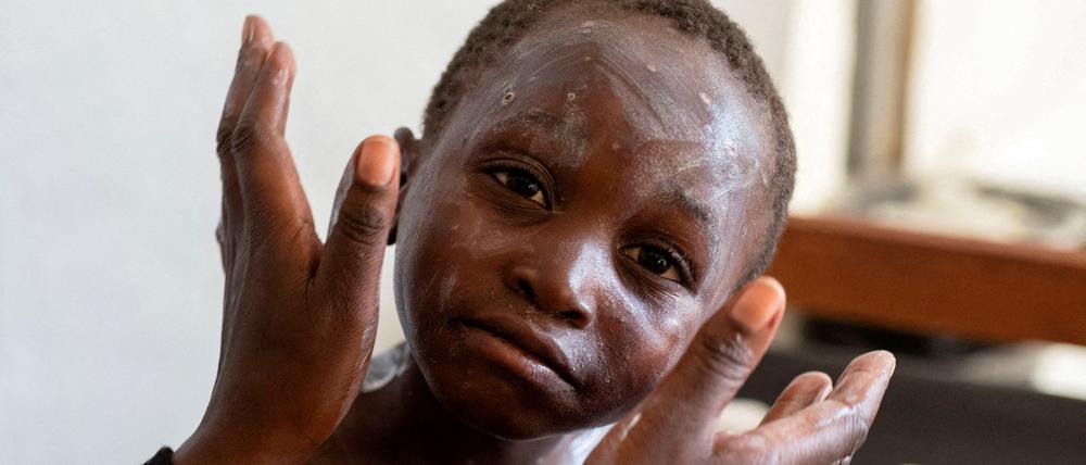 Gesundheitszentrum in Munigi, Demokratische Republik Kongo, 19. August 2024: Sagesse Hakizimana leidet an Mpox. Seine Mutter trägt Salbe auf.