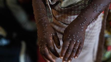 Ein zu leichtfertiger Umgang mit dem Virus könnte Mpox zu einer ernsten globalen Gesundheitsbedrohung werden lassen, warnt ein britisches Forscherduo im Fachmagazin „Nature Medicine“.