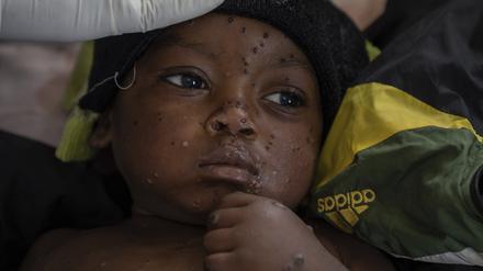 Emile Miango, 2, der an Mpox erkrankt ist, liegt im Krankenhaus, in Kamituga, Provinz Süd-Kivu, die das Epizentrum des jüngsten Ausbruchs der Krankheit im Osten des Kongo ist.