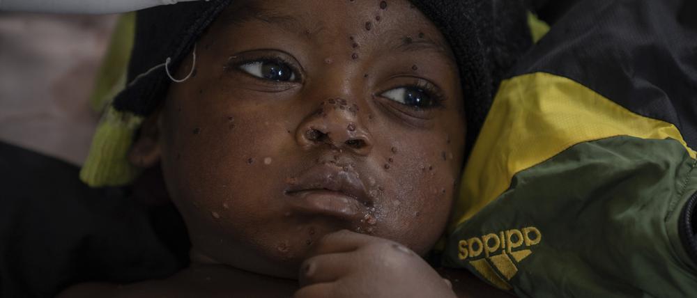 Emile Miango, 2, der an Mpox erkrankt ist, liegt im Krankenhaus, in Kamituga, Provinz Süd-Kivu, die das Epizentrum des jüngsten Ausbruchs der Krankheit im Osten des Kongo ist.