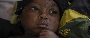 Emile Miango, 2, der an Mpox erkrankt ist, liegt im Krankenhaus, in Kamituga, Provinz Süd-Kivu, die das Epizentrum des jüngsten Ausbruchs der Krankheit im Osten des Kongo ist.