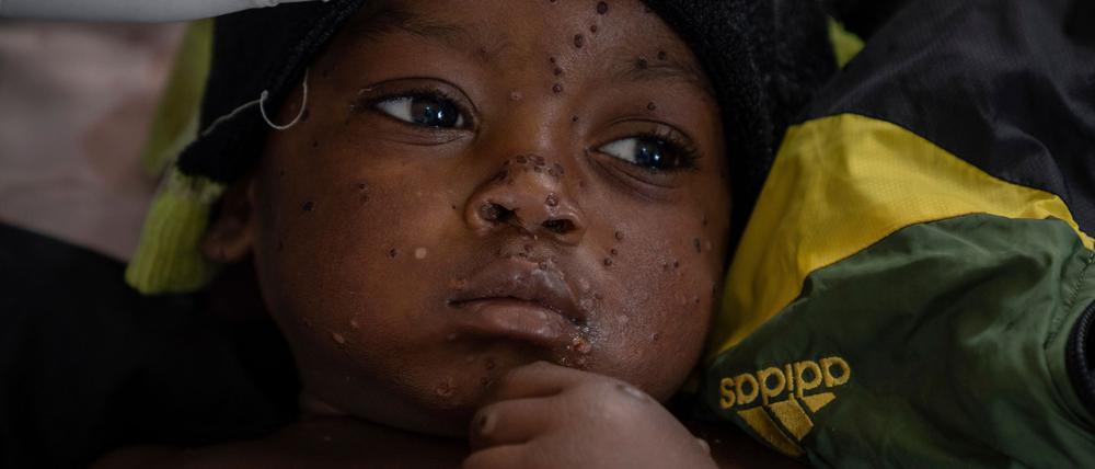 Neue Tests sollen die Ausbreitung von Mpox eindämmen helfen. (Archivbild)