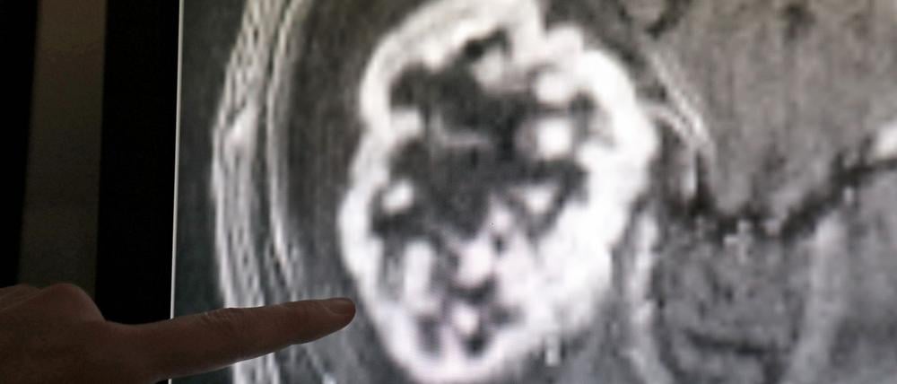 miRNAs spielen eine große Rolle bei Tumoren. (Archivbild)
