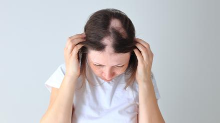 Eine junge Frau zeigt ihren Kopf mit Haarausfall (Symbolbild). 