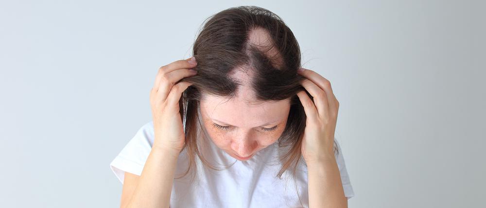 Eine junge Frau zeigt ihren Kopf mit Haarausfall (Symbolbild).