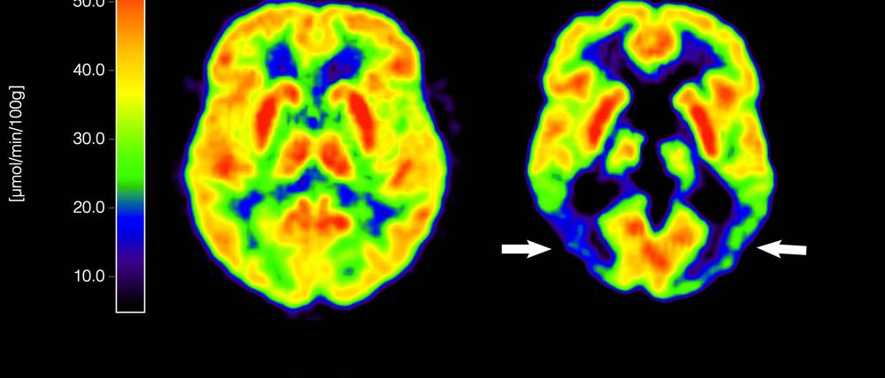 Haben die Amyloid-Plaques schon irreversible Schäden im Gehirn angerichtet, nützt ihre Entfernung nichts mehr. (Archivbild)