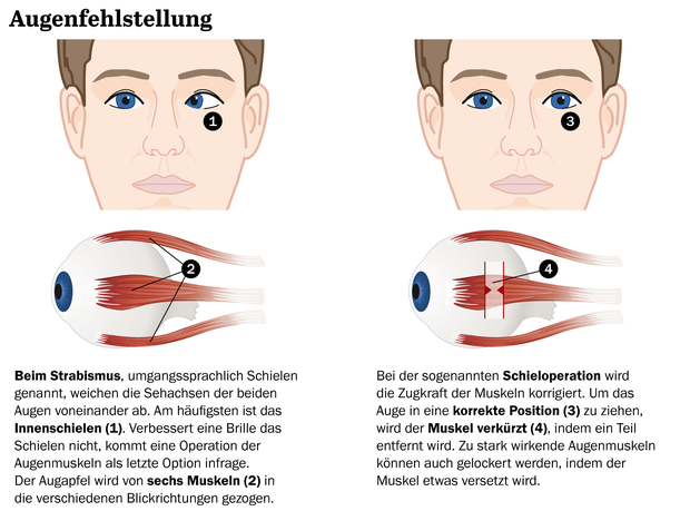 Können Die Augen Beim Schielen Stehen Bleiben www.tagesspiegel.de