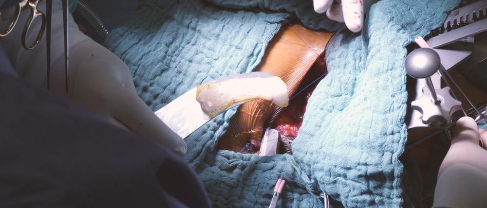 Bei einer Operation setzen Ärzte ein „Herzpflaster“ ein.