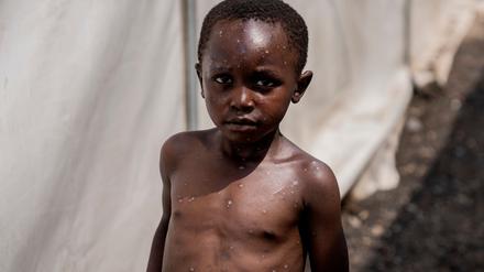 Für Kinder kann Mpox besonders gefährlich sein (Archivbild) 