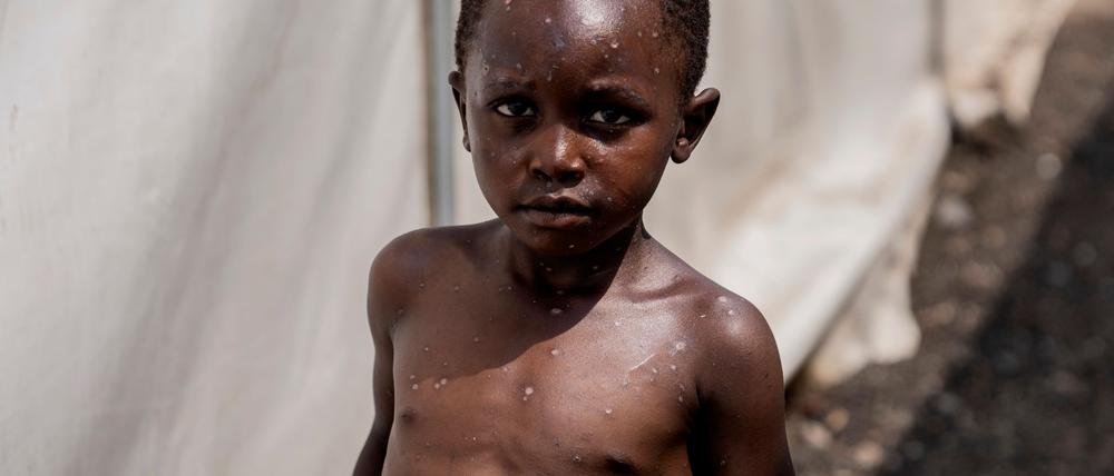 Für Kinder kann Mpox besonders gefährlich sein (Archivbild)