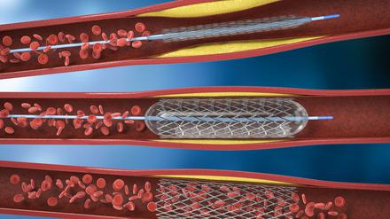 Bildliche Darstellung eines sogenannten Stents.